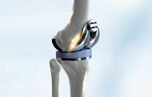 Orthopedics Center, Knee replacement surgery, pain management