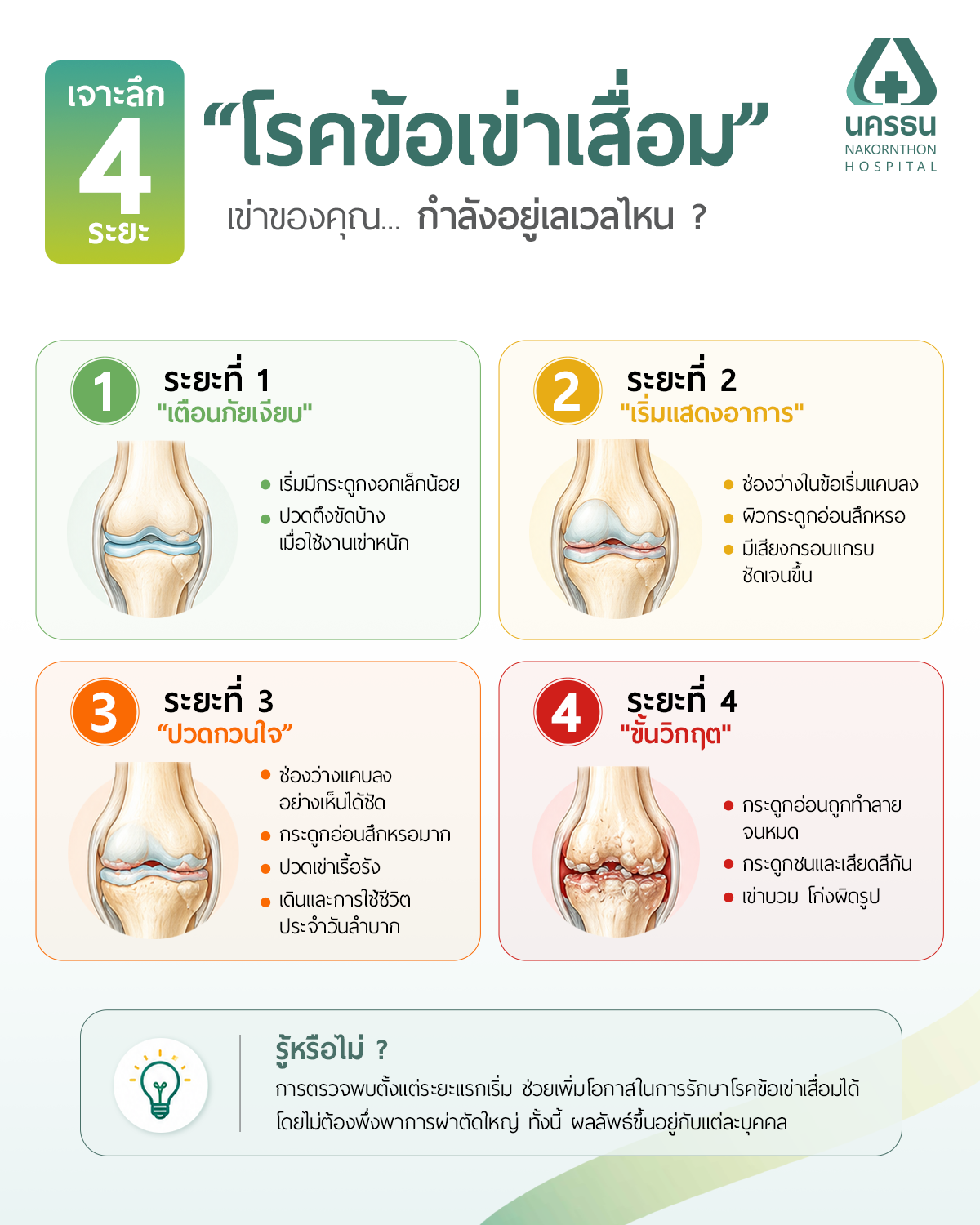 การเปลี่ยนแปลงของกระดูกอ่อนใน 4 ระยะของโรคข้อเข่าเสื่อม