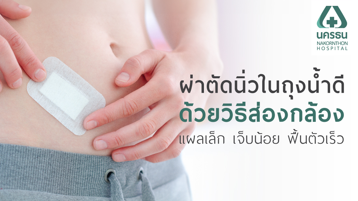 ผ่าตัดนิ่วในถุงน้ำดีด้วยวิธีส่องกล้อง