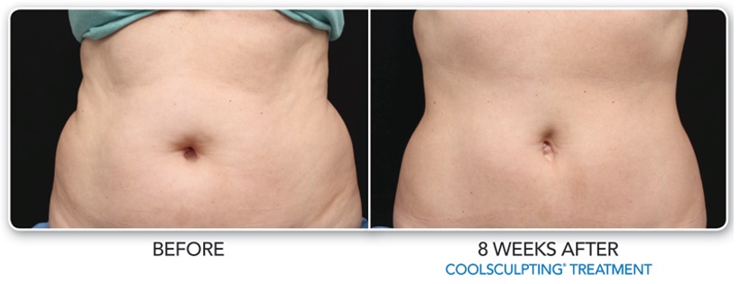 CoolSculpting treatment