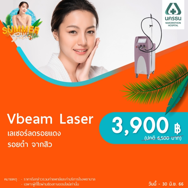 Vbeam Laser
