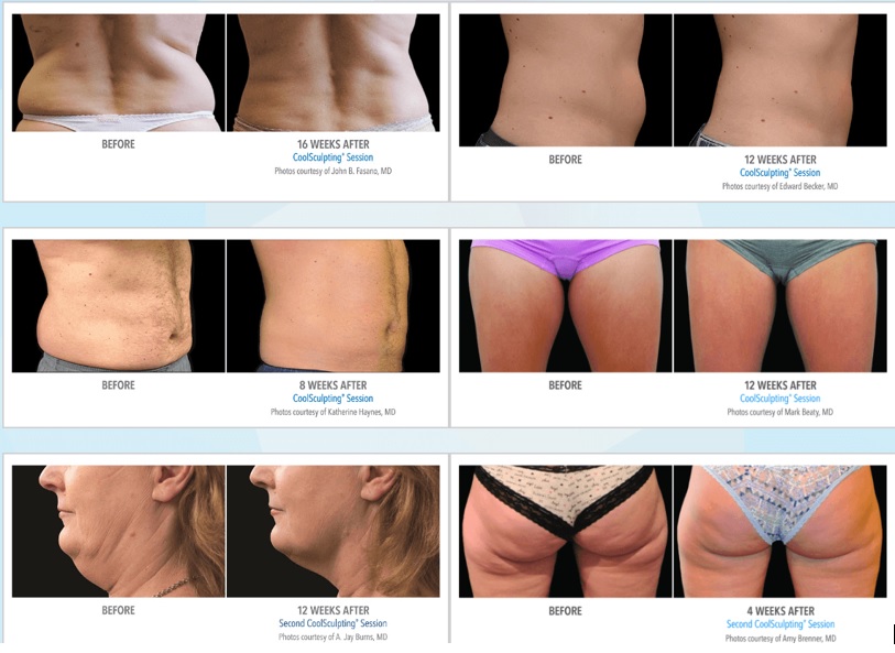 CoolSculpting treatment