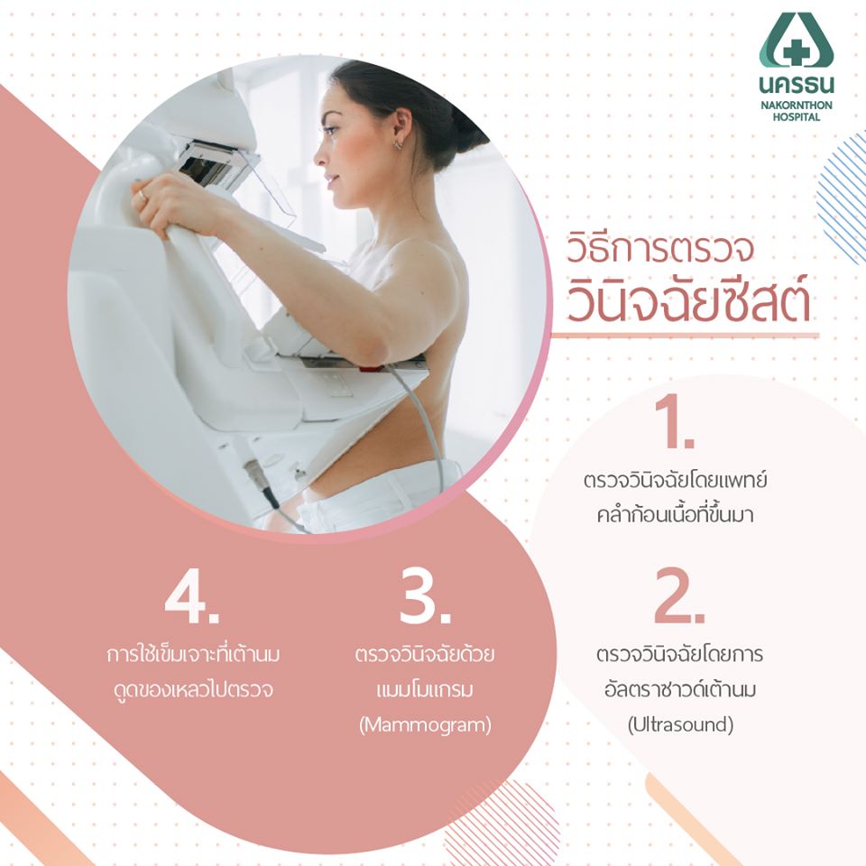 ซีสต์ในเต้านม, ถุงน้ำในเต้านม