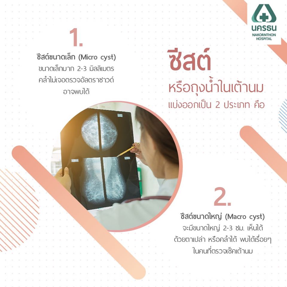 ซีสต์ในเต้านม, ถุงน้ำในเต้านม