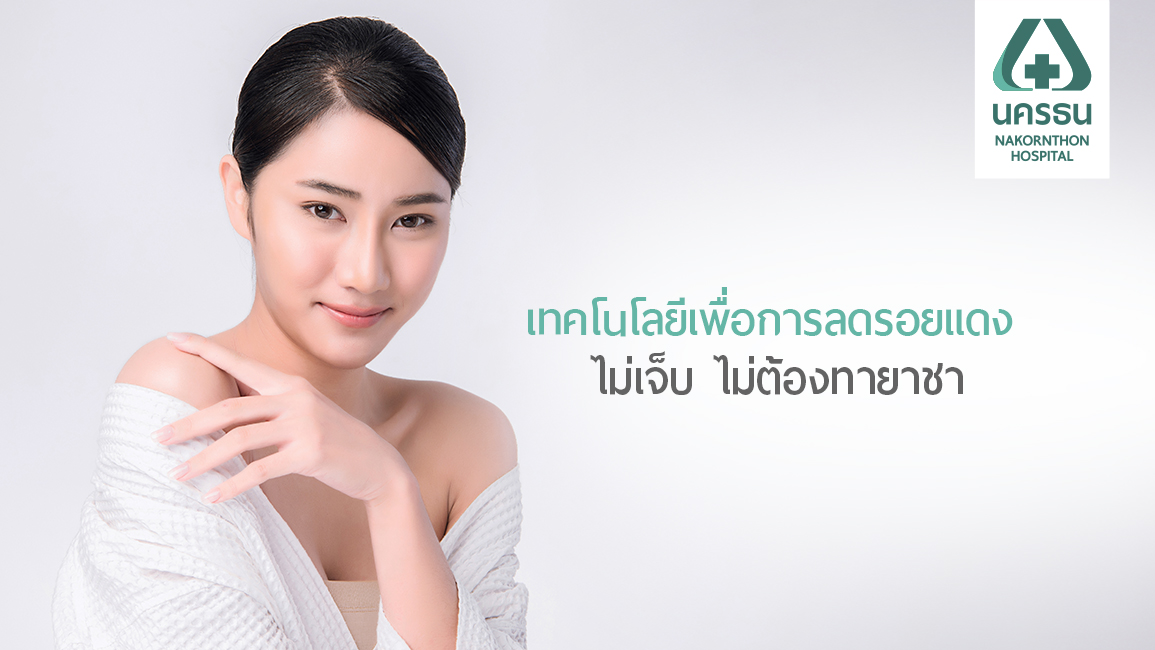Vbeam เพื่อผิวเนียนใส ไร้รอยสิว