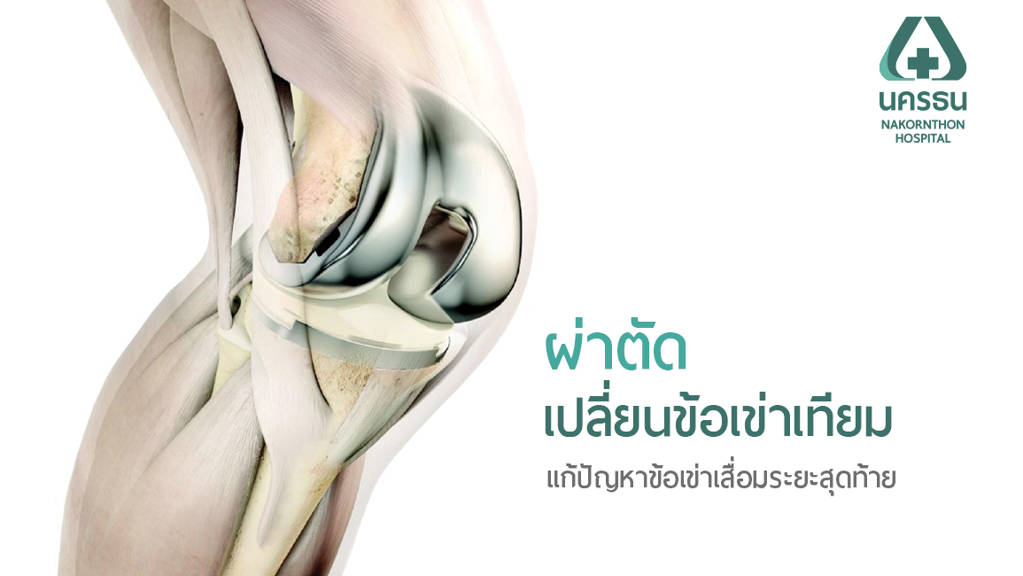 ก้าวใหม่ได้อีกครั้ง กับการผ่าตัดเปลี่ยนผิวข้อเข่าเทียม