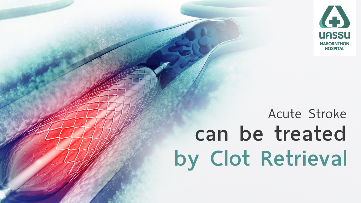 clot retrieval