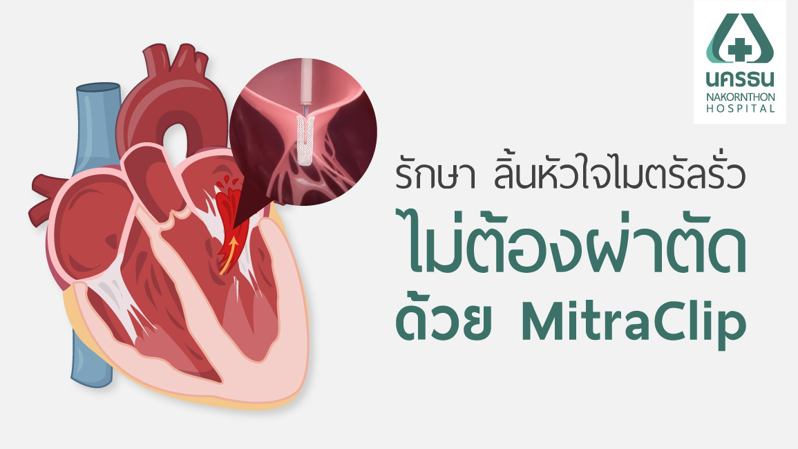 ลิ้นหัวใจไมตรัลรั่ว ลิ้นหัวใจไมตรัลรั่ว