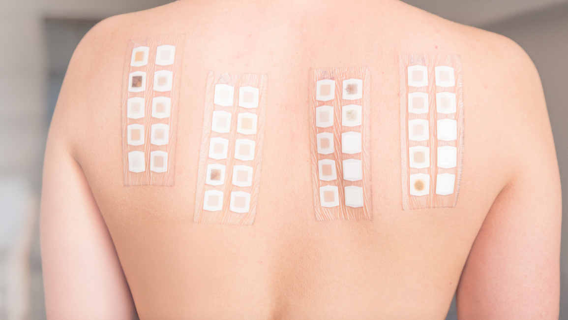 Patch Test คืออะไร ทดสอบอาการแพ้ที่ช่วยหาสาเหตุผิวแพ้ | โรงพยาบาลนครธน