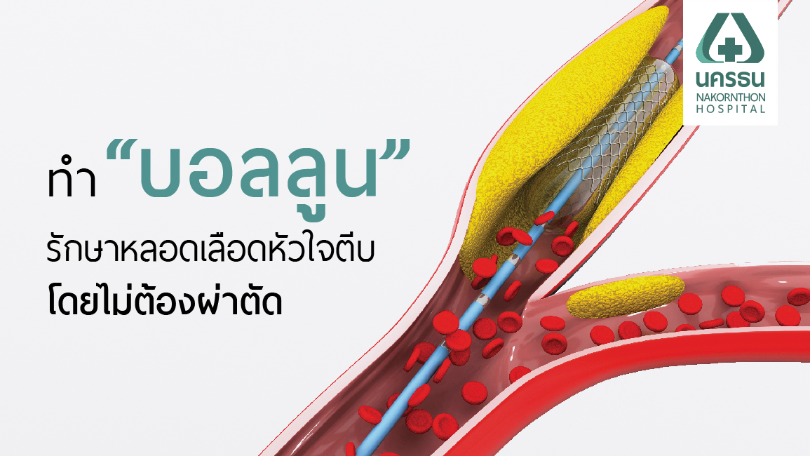 บอลลูนหัวใจ