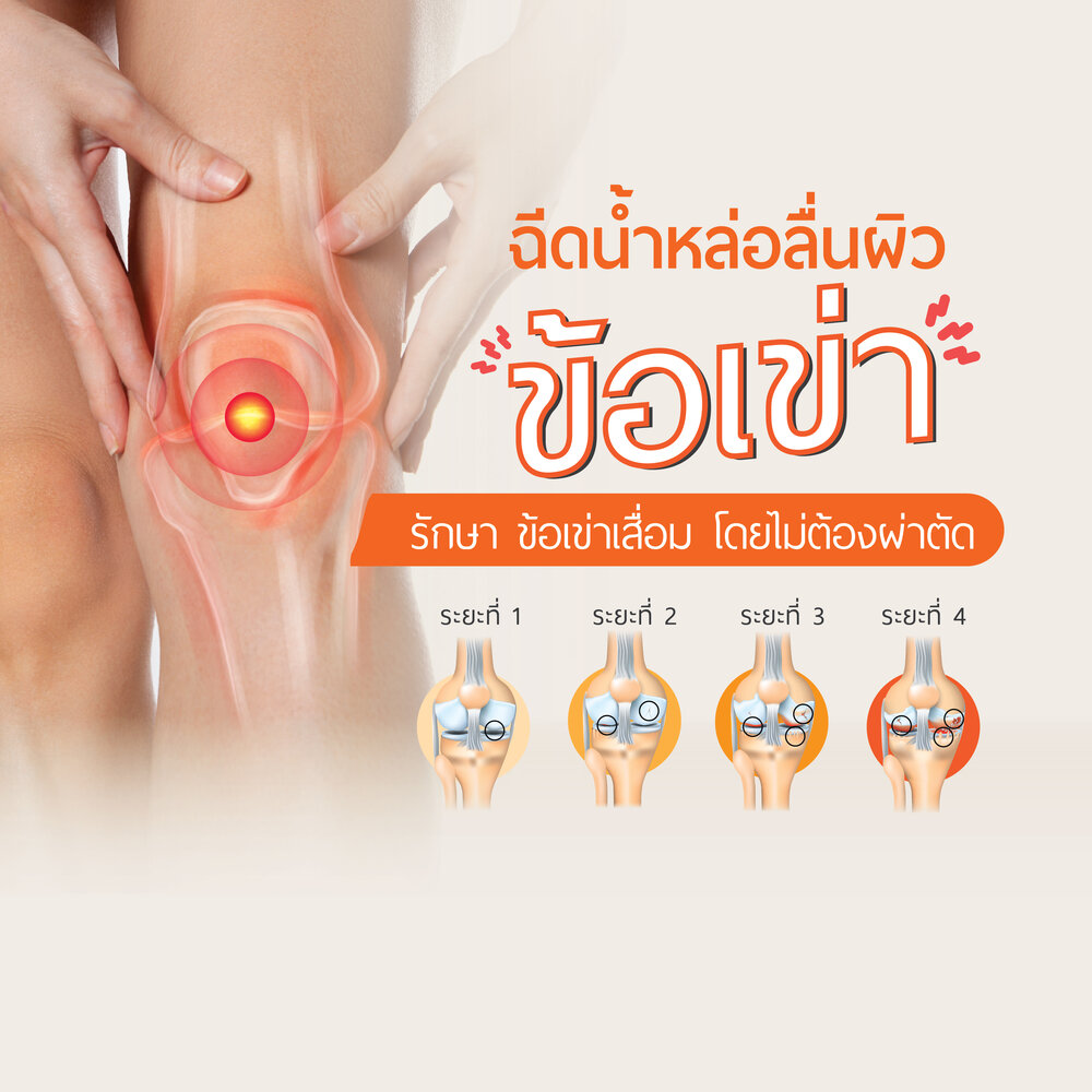 โปรแกรมฉีดน้ำหล่อลื่นผิวข้อเข่า